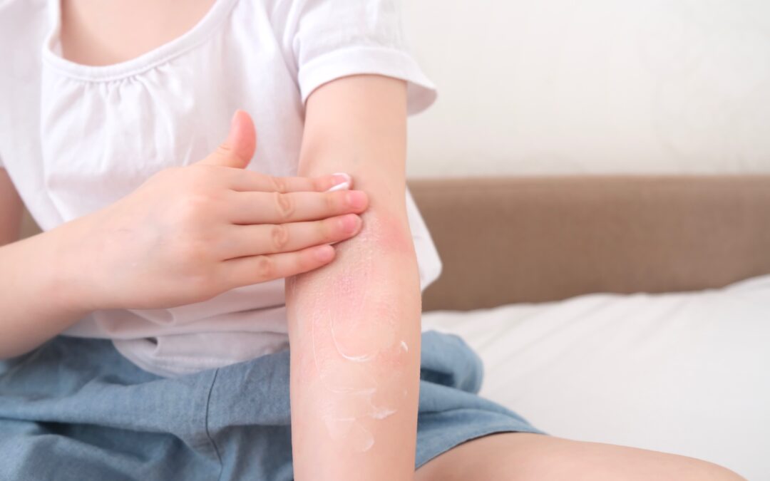 The child applies a special cream to eczema.