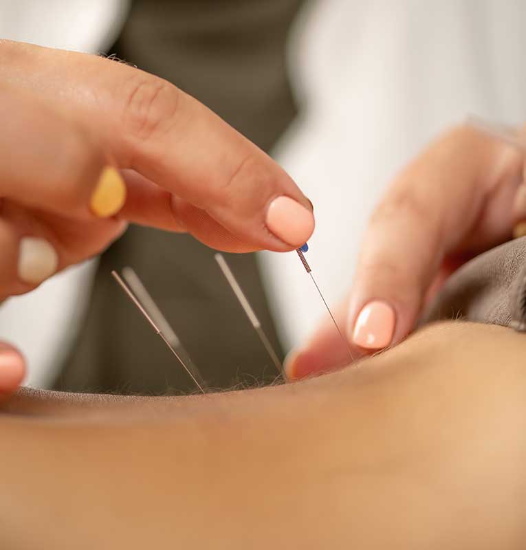 acupuncture